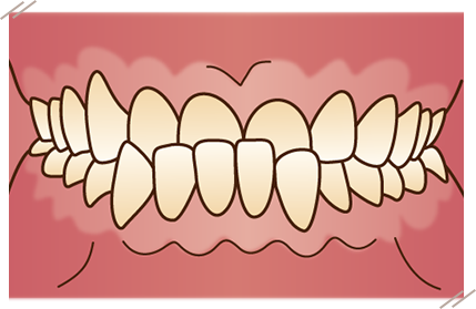 反対咬合の特徴と見分け方