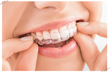 マウスピース矯正（インビザラインなど）