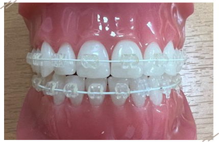 ワイヤー矯正（表側矯正）